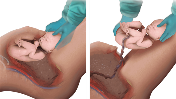 Image of C-section 